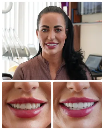 E-max Veneers transformation — Brit Woman